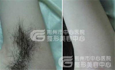 脱腋毛2.jpg