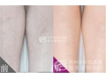 【主任讲解】为什么脱毛不能一次性脱干净
