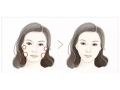 什么人不适合打瘦脸针
